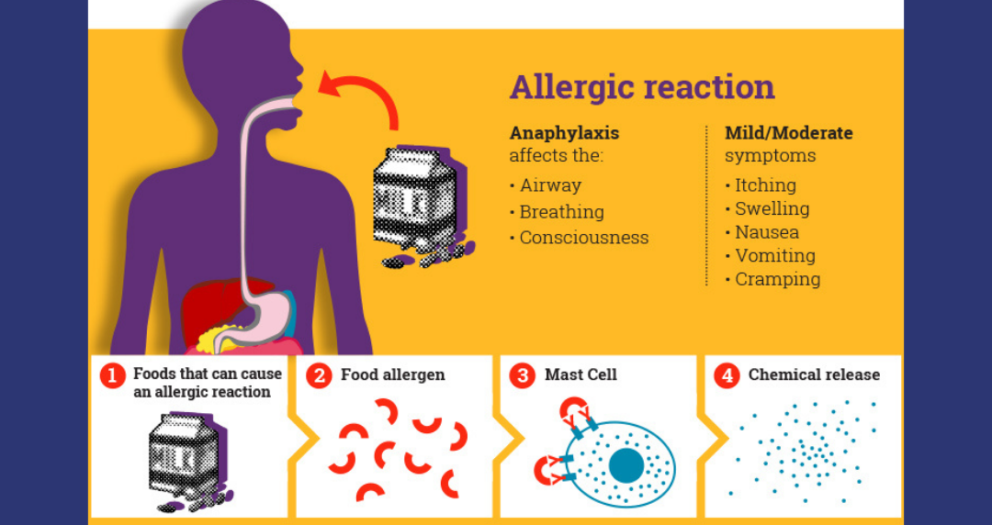 Connection Between Anaphylaxis and Allergies.