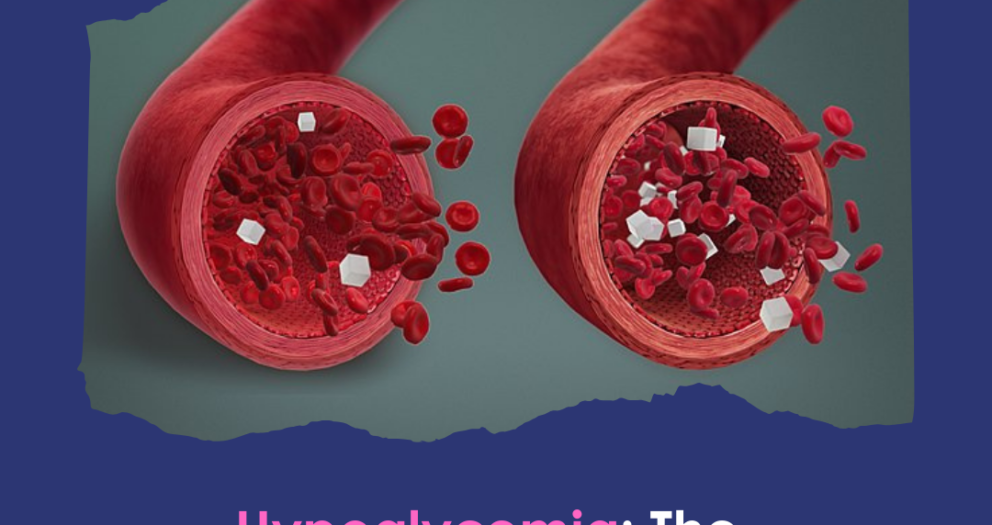 Hypoglycemia: The Condition of Having Blood Sugar Levels Too Low.