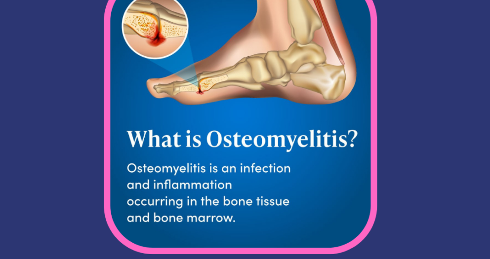 You Must Know About Osteomyelitis.