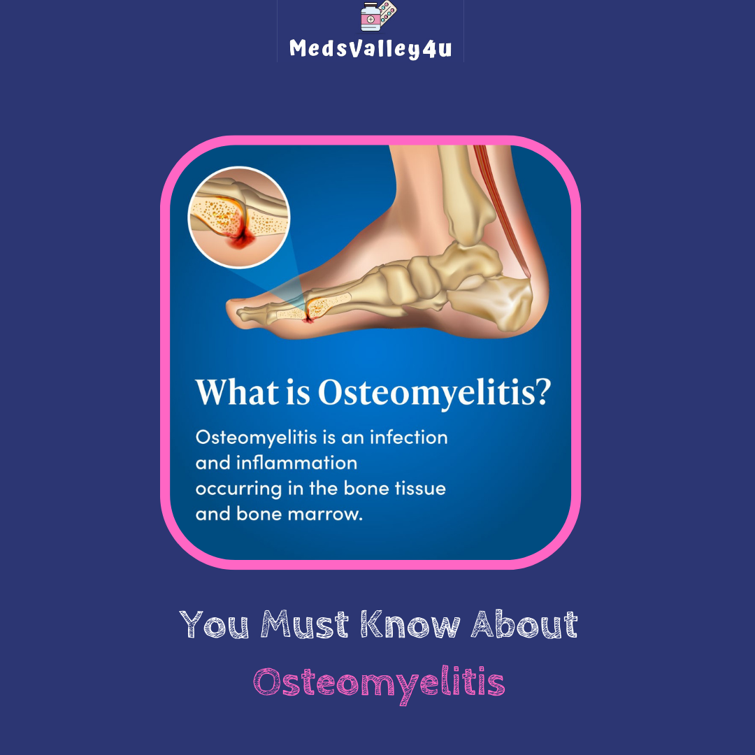 You Must Know About Osteomyelitis.